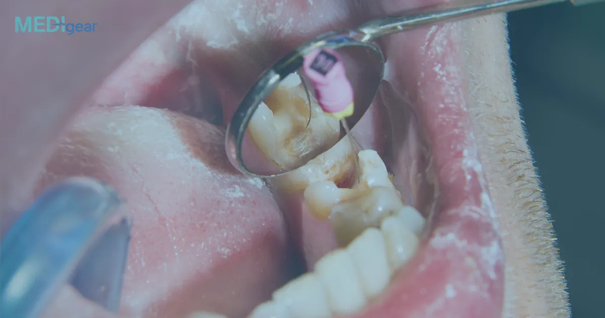 How Do Apex Locators Improve Root-Canal Precision?
